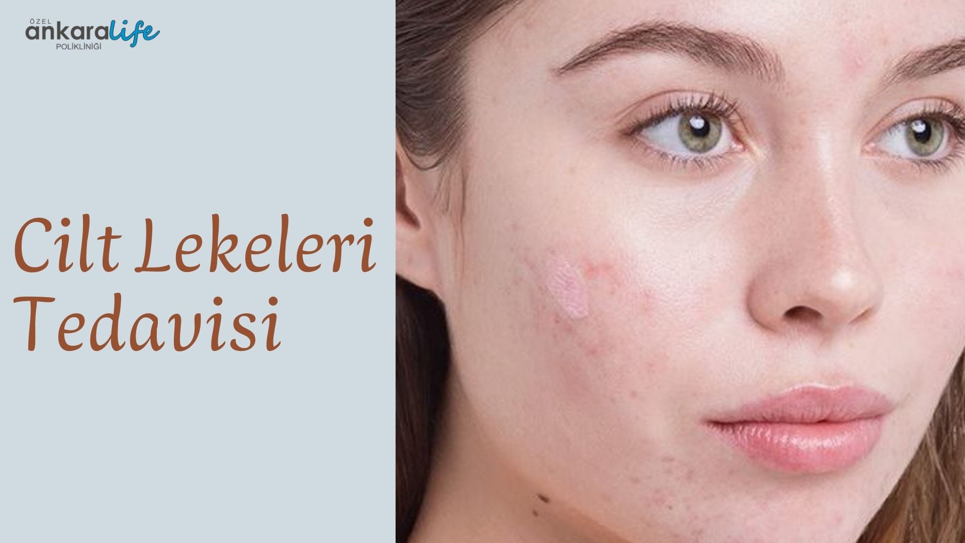 cilt-lekeleri-tedavisi