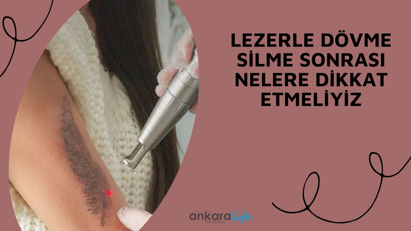 Lazerle Dövme Silme Seansından Sonra Dikkat Edilmesi Gerekenler
