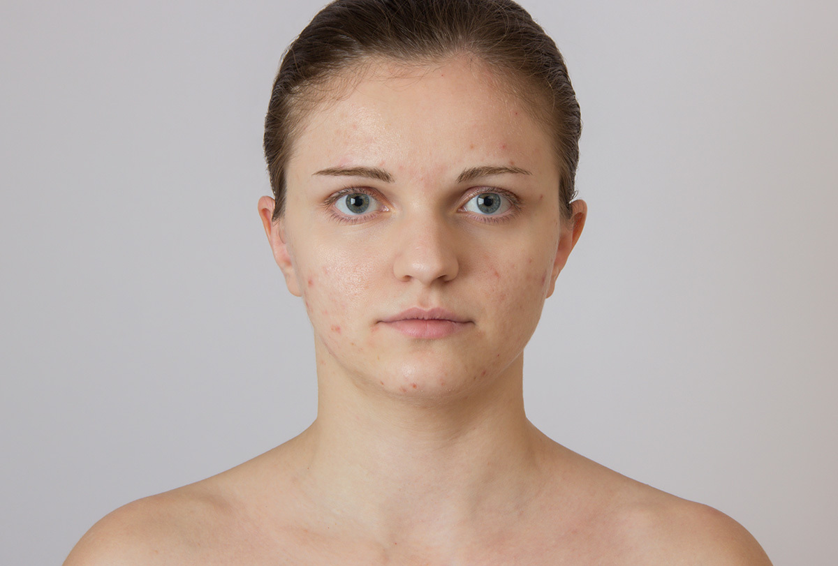 hormonal-acne-treatment