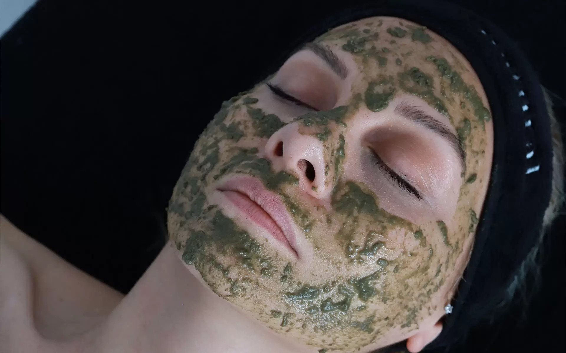 yosun-peeling-leke-tedavisi