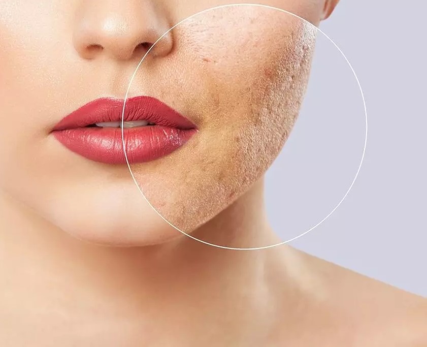 dermapen-leke-tedavisi