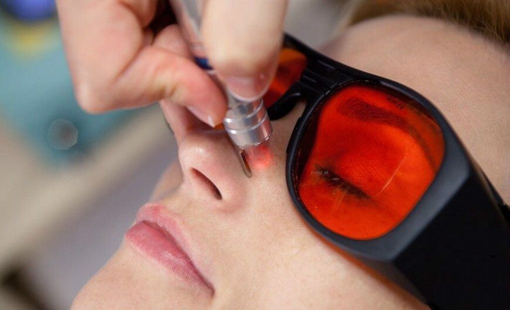 burun-cevresindeki-kilcal-damarlar-tedavisi