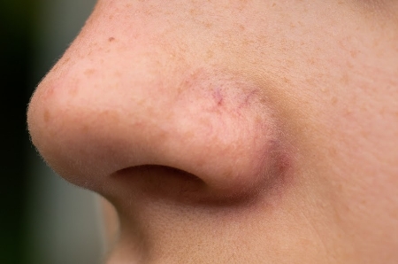 burun-kilcal-damar-catlamasi-lazer-tedavisi-fiyatlari