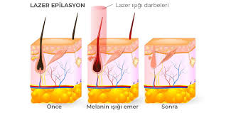 Epilasyon-nedir