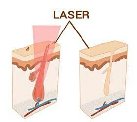 lazer-epilasyon-kanser-tedavisine-engel-mi