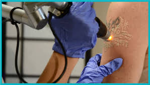 picosure-dovme-silme
