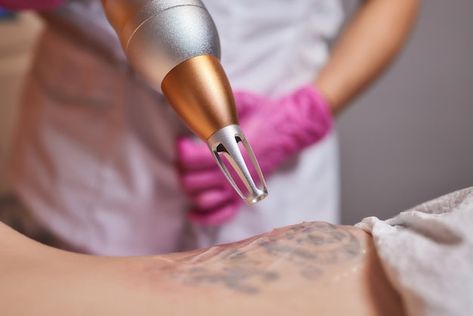 dovme-silme-picosure