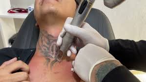 tattoo-sildirme