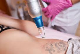 tattoo-silinmesi