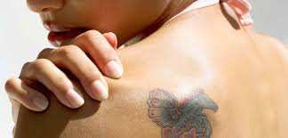 kimyasal-peeling-ile-dovme-silme