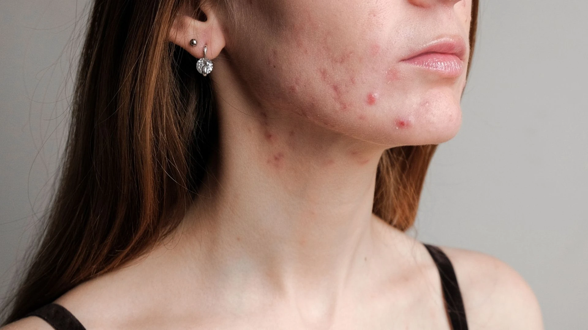 dermatologlarin-onerdigi-sivilce-kremi