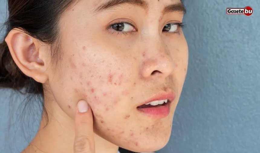 roaccutane-sivilce-ilaci