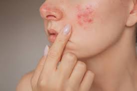 akne-peeling-tedavisi