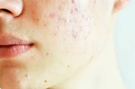 bepanthol-anti-scar-jel-sivilce