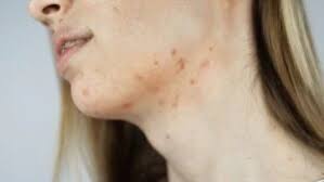 cilt-lekeleri-ve-sivilce-izleri-icin-krem