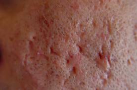 genital-bolgede-buyuk-sivilce-nasil-gecer