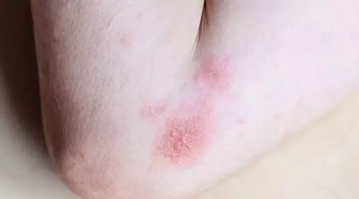 koldaki-sivilce-izlerine-ne-iyi-gelir