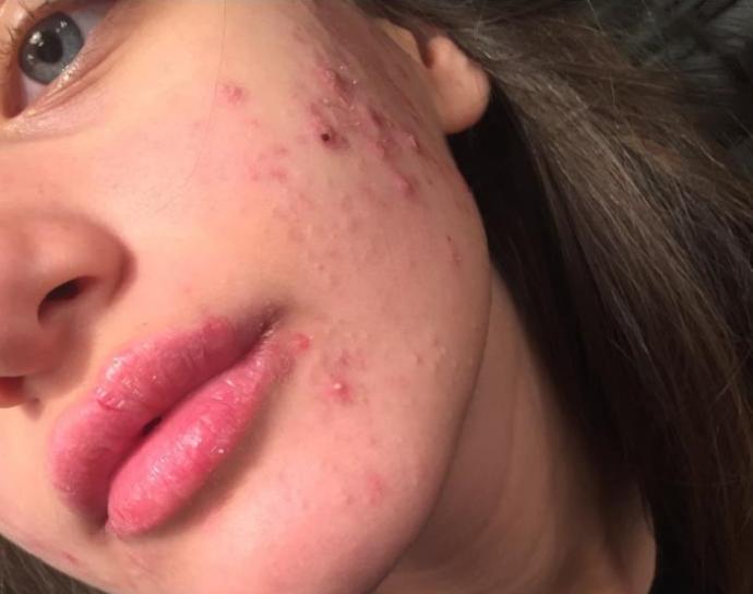 roaccutane-sivilce-izlerini-yok-eder-mi