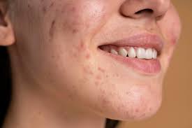 dermapen-sivilce-izlerine-iyi-gelir-mi