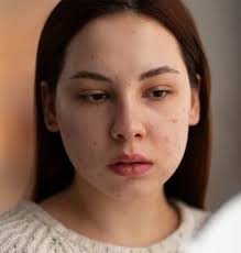 sivilce-izi-icin-retinol