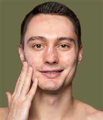 la-roche-posay-sivilce-izlerine-iyi-gelir-mi