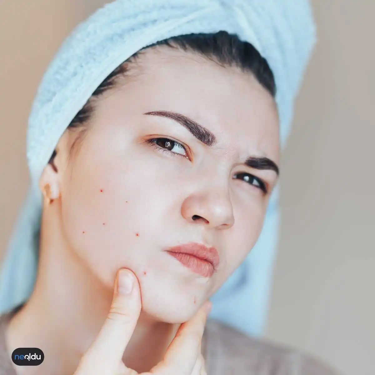 baby-face-beauty-sivilce-izleri