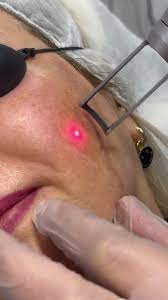 q-switch-laser