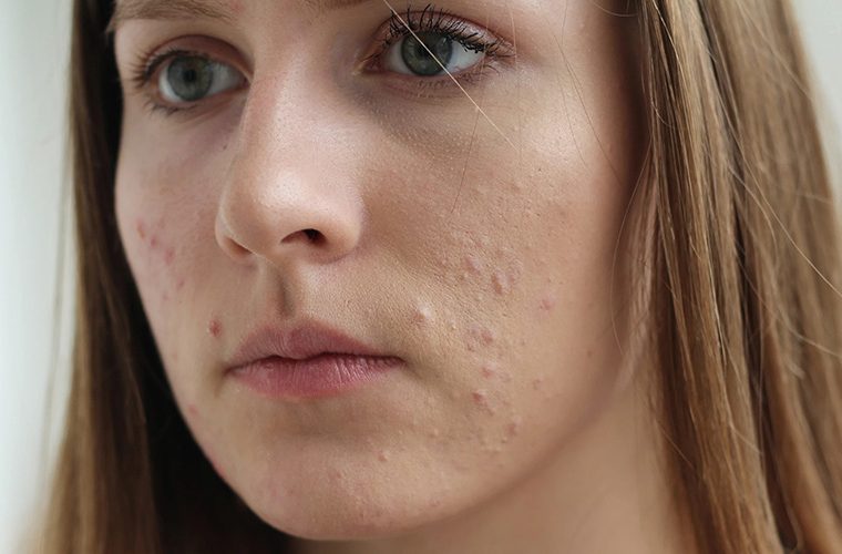 roaccutane-dan-sonra-leke-tedavisi