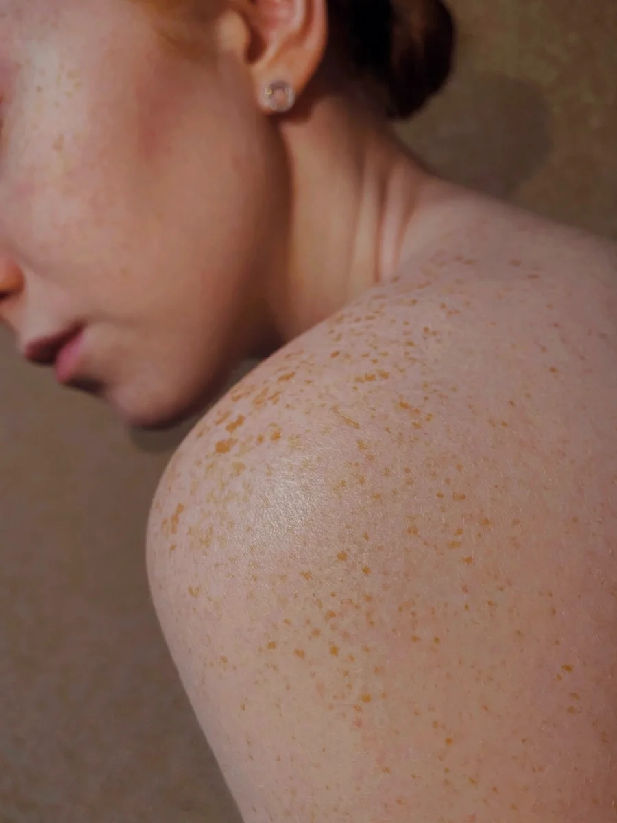 melasma-leke-tedavisi-kendiliginden-gecer-mi