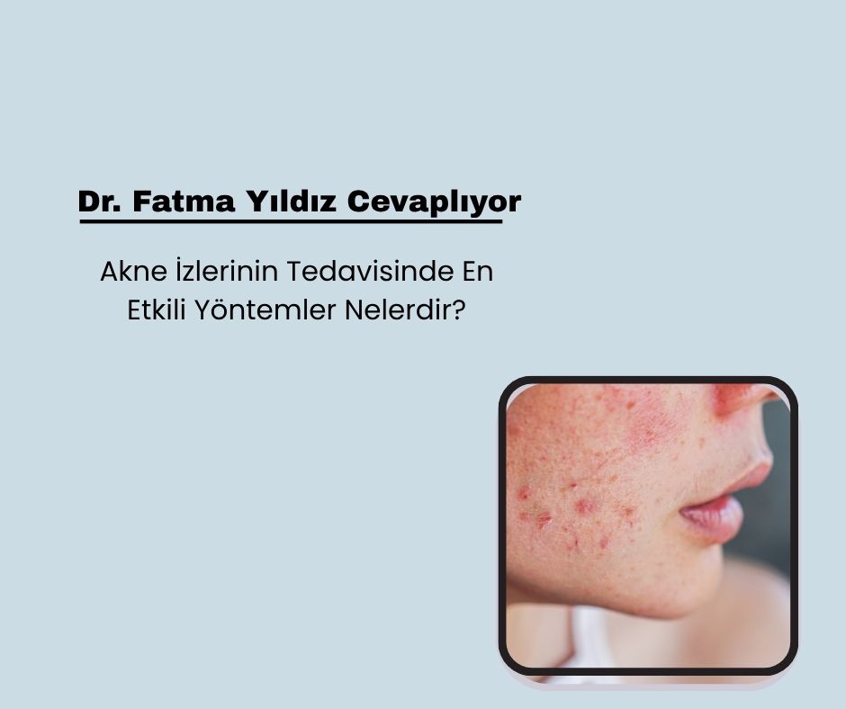 Akne İzlerinin Tedavisinde En Etkili Yöntemler Nelerdir?
