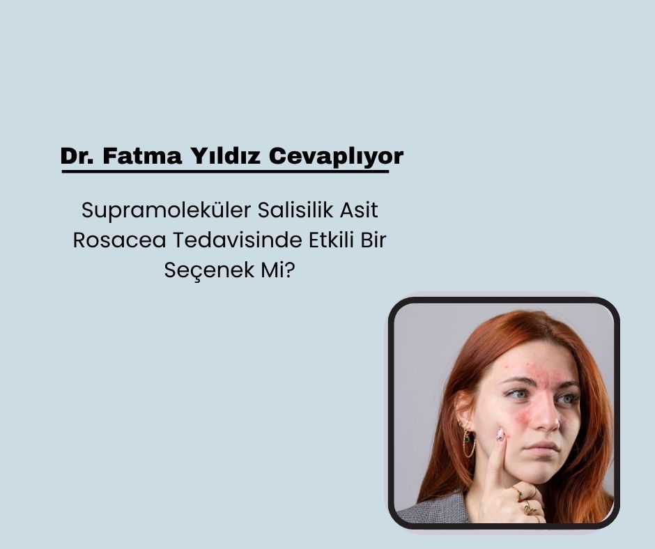 Supramoleküler Salisilik Asit Rosacea Tedavisinde Etkili Bir Seçenek Mi?