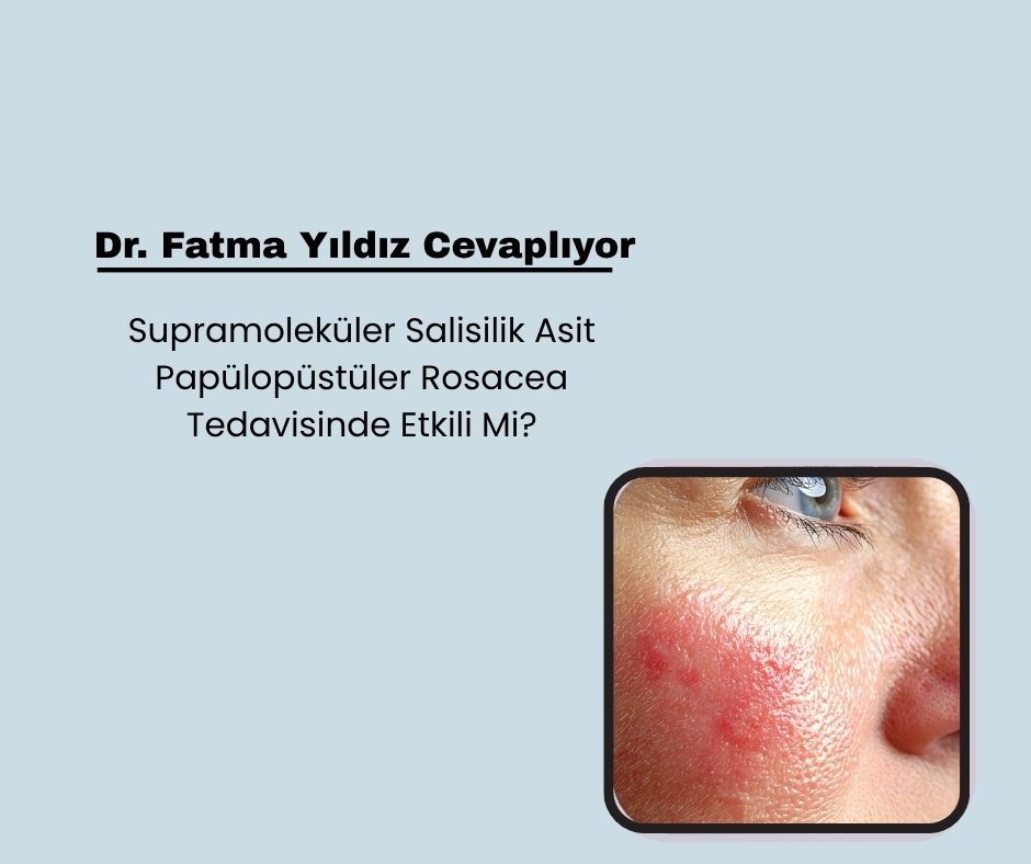 Supramoleküler Salisilik Asit Papülopüstüler Rosacea Tedavisinde Etkili Mi?