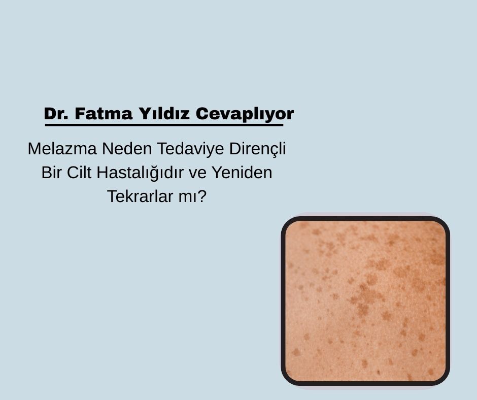 Melazma Neden Tedaviye Dirençli Bir Cilt Hastalığıdır ve Yeniden Tekrarlar mı?