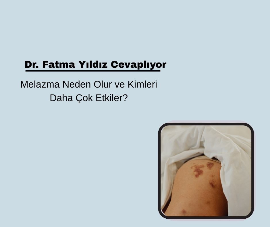 Melazma Neden Olur ve Kimleri Daha Çok Etkiler?