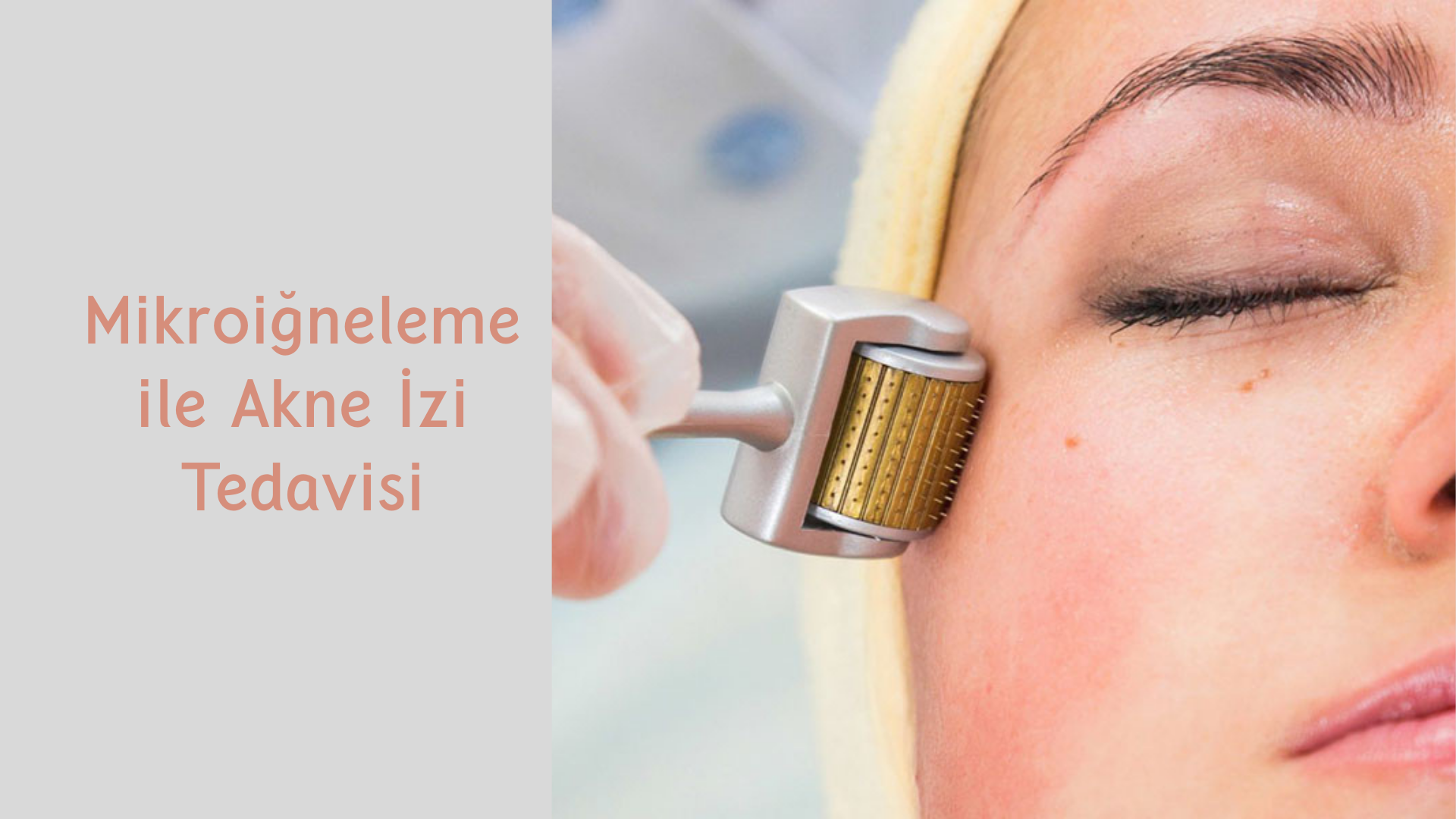 ankara mikroigneleme ile akne izi tedavisi